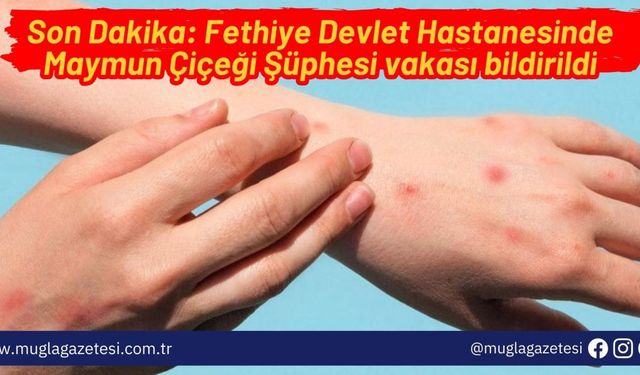 Son Dakika: Fethiye Devlet Hastanesinde Maymun Çiçeği Şüphesi vakası bildirildi