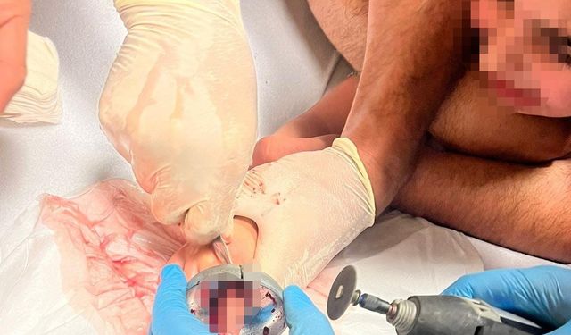 5 Yaşındaki Çocuğun Parmağı Çeşme Aynasına Sıkıştı